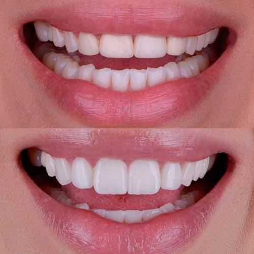 Digital Smile Design Preview