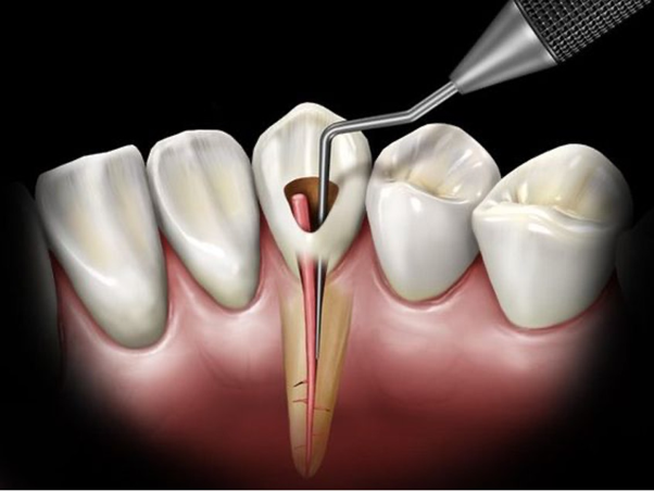 Endodoncia Clínica Dentalemán