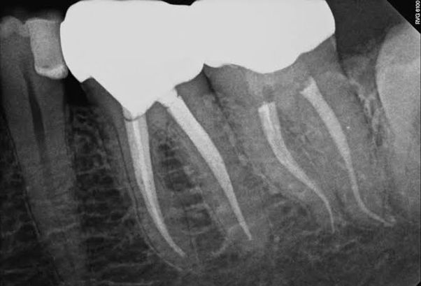 Especialistas en Endodoncia Dentalemán