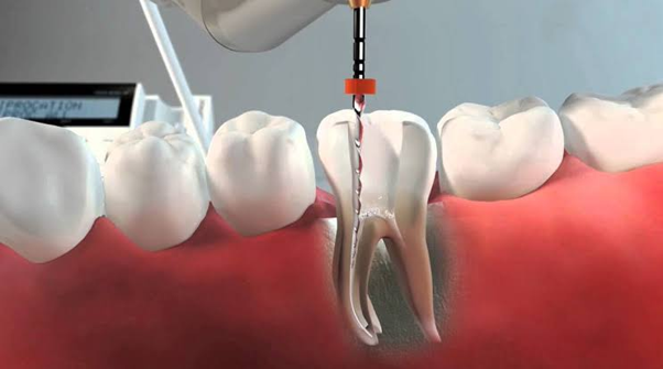 Endodontic Specialists Dentalemán