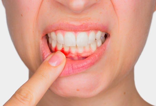 Tratamiento periodontal 1