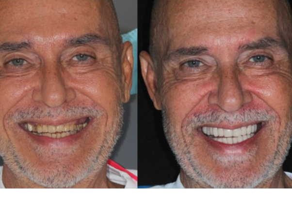 Caso de éxito rehabilitación oral 1