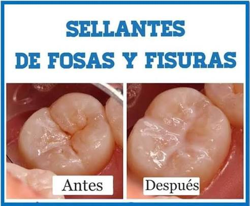 anatomía dental y selladores