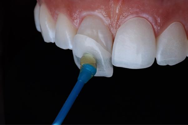 Dental Veneers