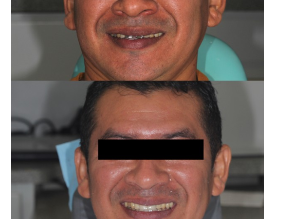 Caso de éxito coronas dentales 1
