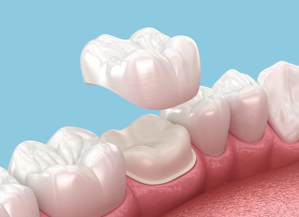 Coronas dentales Dentalemán