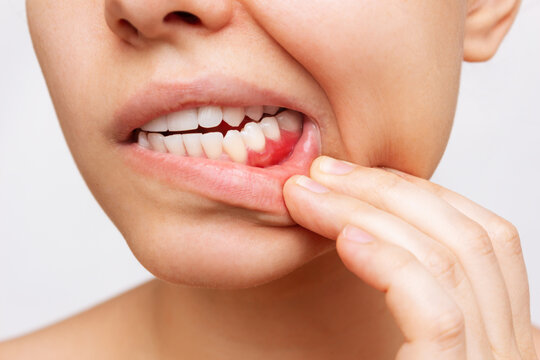Tratamiento periodontal 4