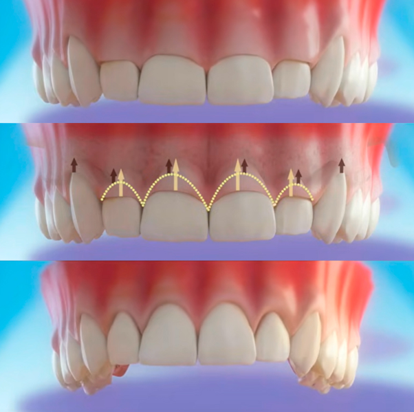 Tratamiento periodontal 2