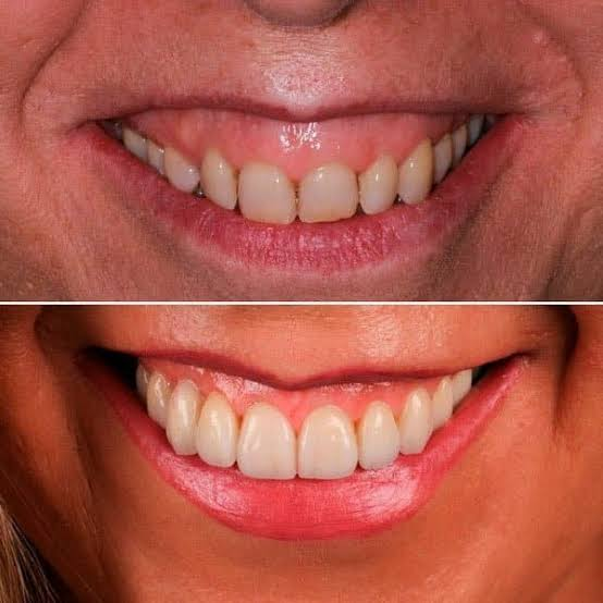 Tratamiento periodontal 3