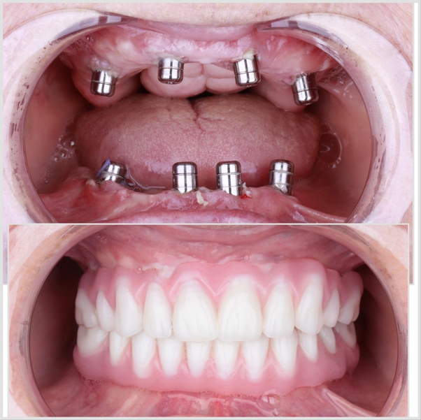 Rehabilitación Oral Completa