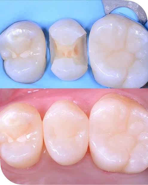 Resinas Dentales de Alta Estética en Mérida Yucatán