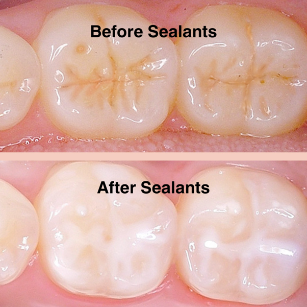 Dental Sealants