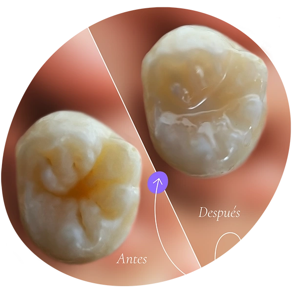 selladores dentales