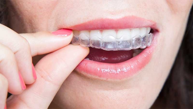Clear Aligner Therapy