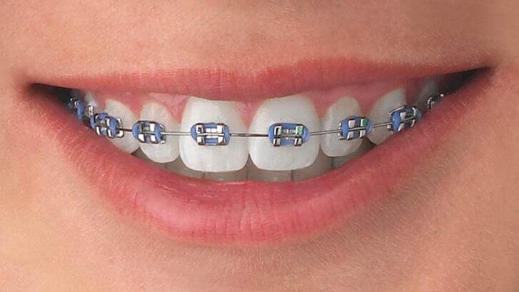 Complex Bite Correction