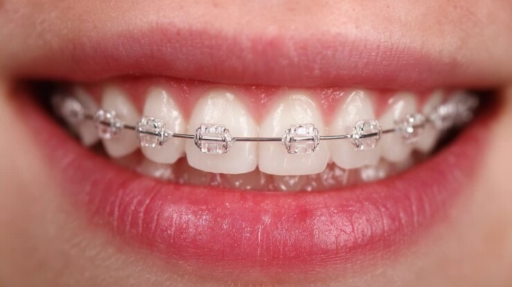 Self-Ligating Ceramic Braces