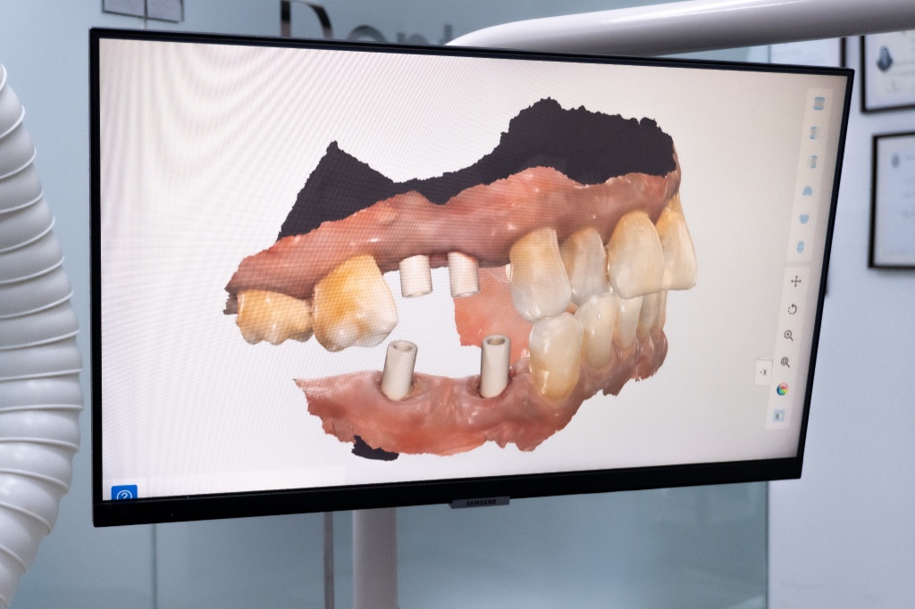 Dental implant procedure