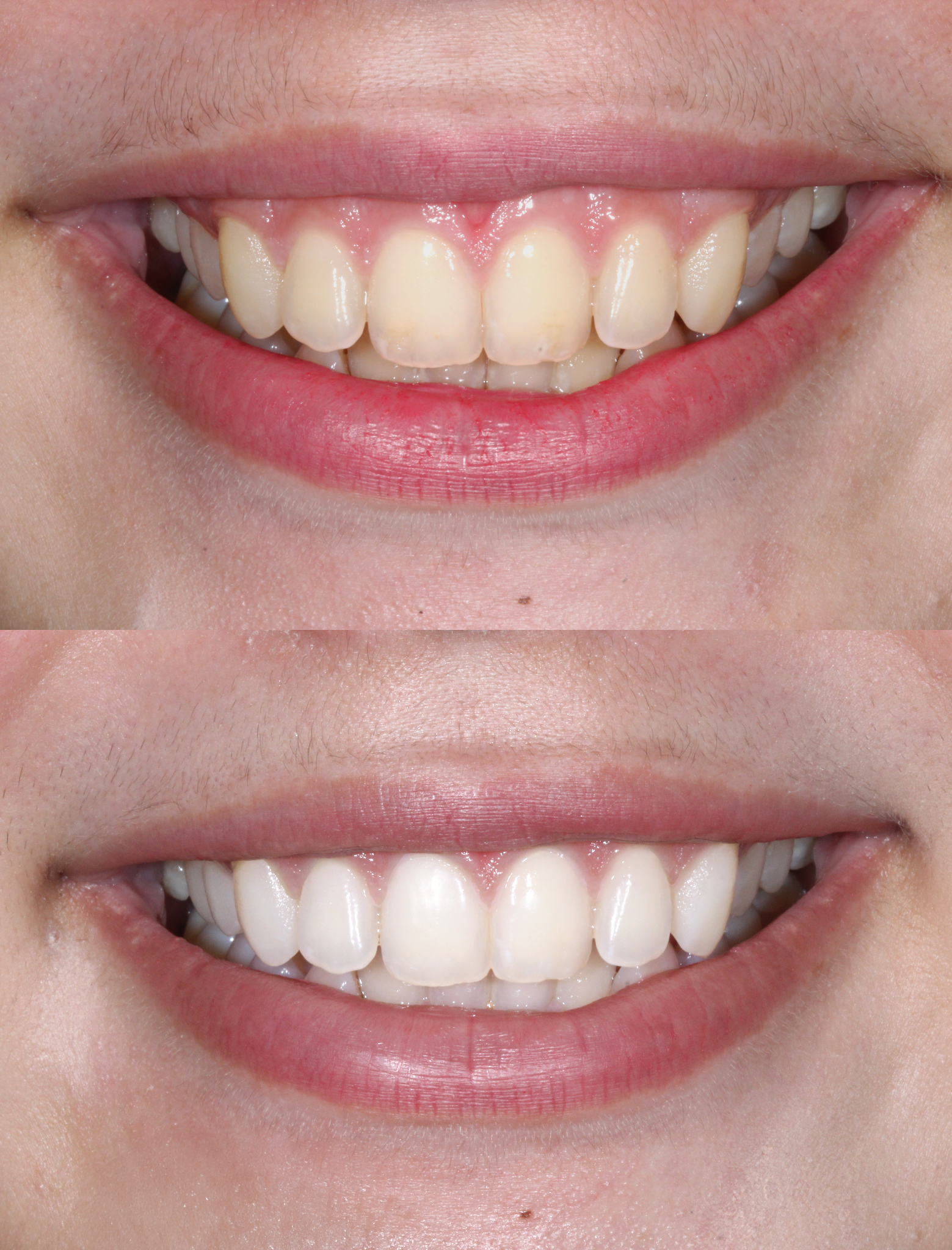 Advanced Laser Teeth Whitening in Mérida