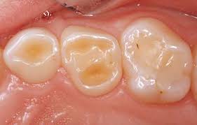¿Qué es la Erosión Dental?