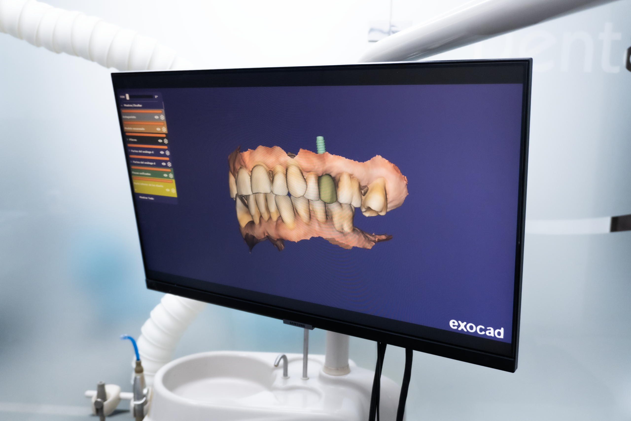 Smile Design - Dental Implants